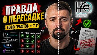 HFE пересадка волос — честный разбор без прикрас