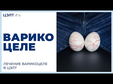 🏥 Варикоцеле. Лечение варикоцеле в ЦЭЛТ.