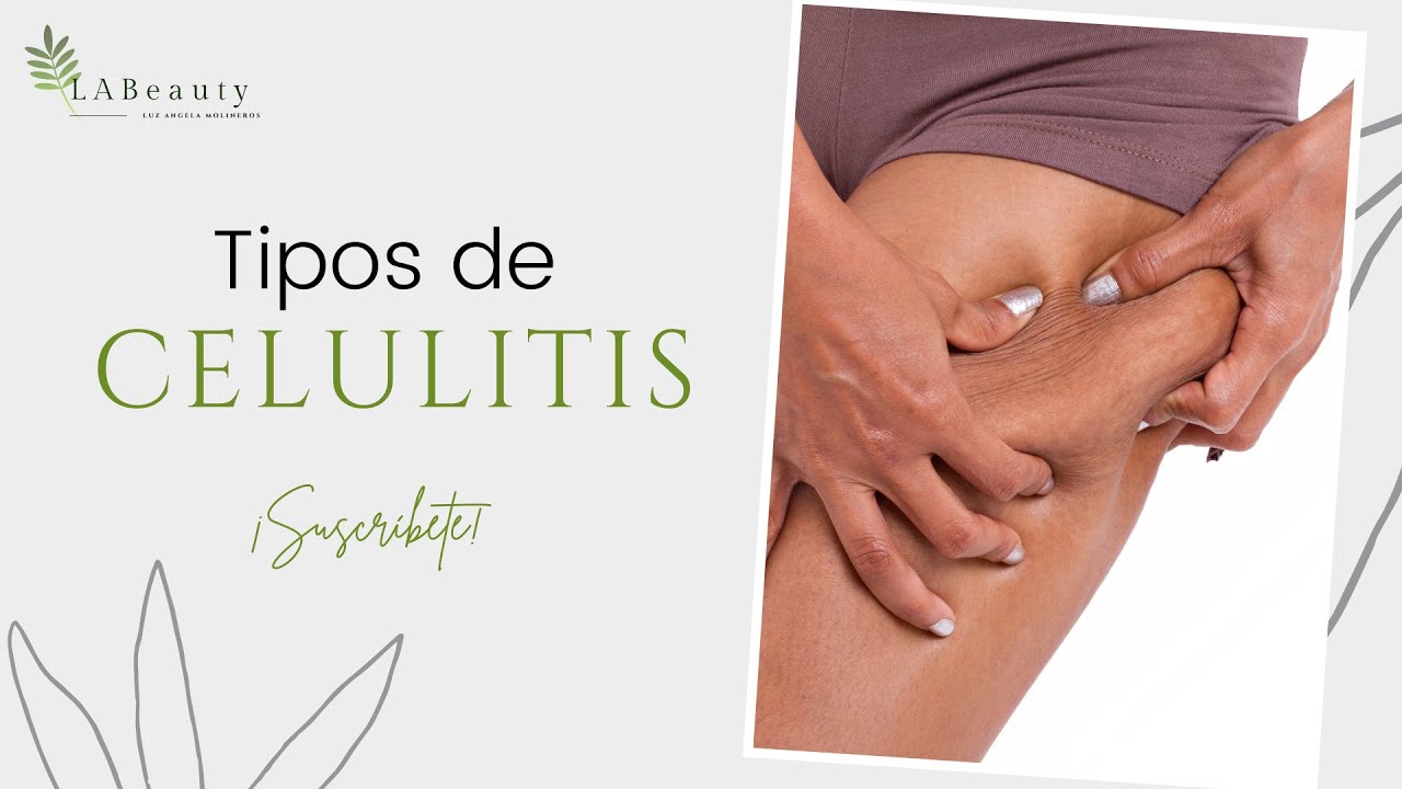 Descubre los tipos de celulitis