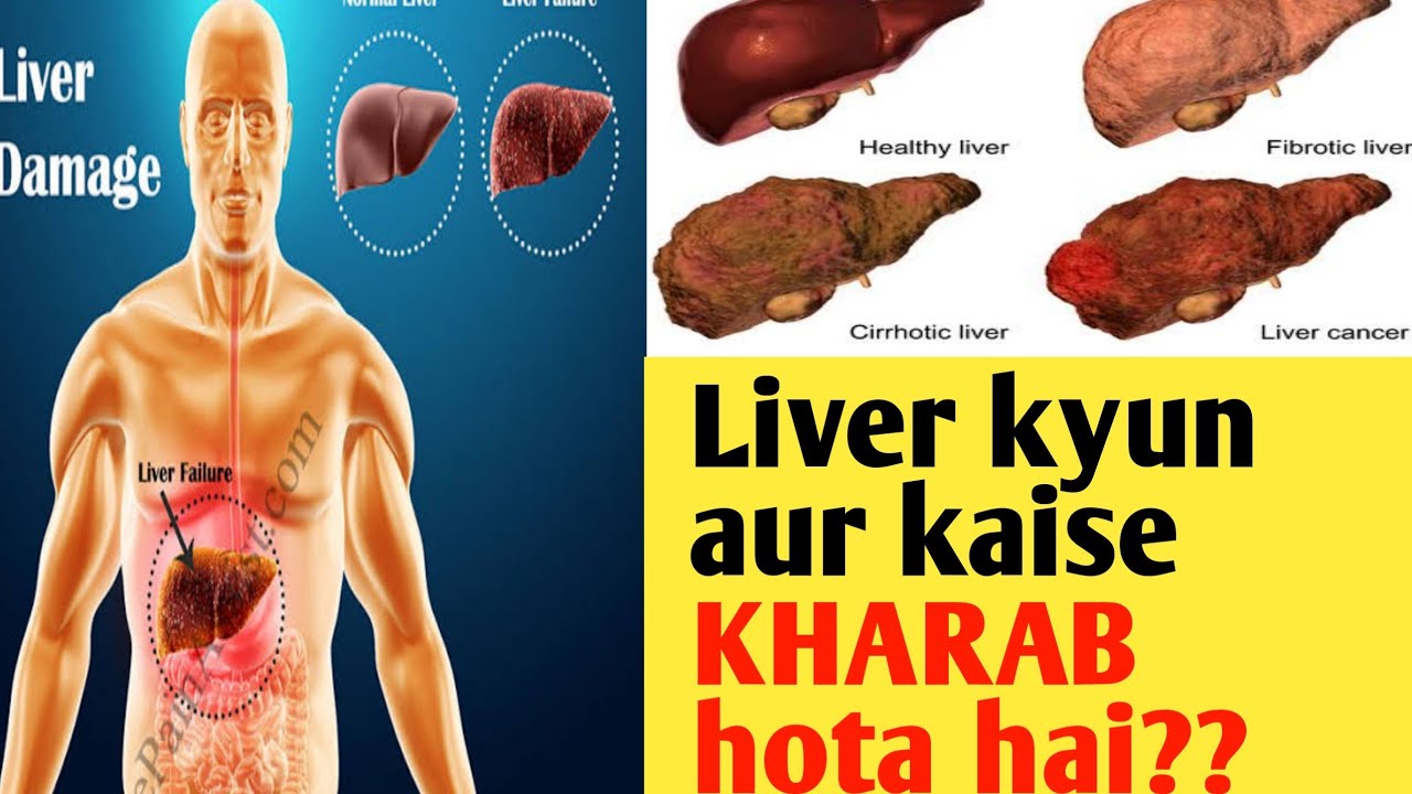 liver kyu aur kaise kharab hota hai janiye Khan sir se।। YouTube