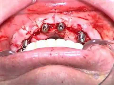 Immediate Loading of the Edentulous Maxilla | Part 4