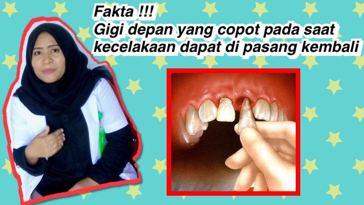 Gigi Jatuh Pada Usia 20 Tahun Bolehkah Ia Tumbuh Semula Gigi 2021