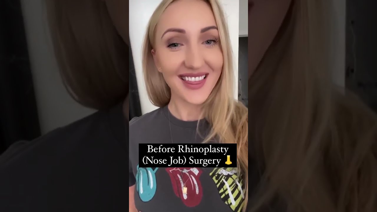Nose Job Transformation