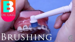 Brushing Your Teeth with Braces