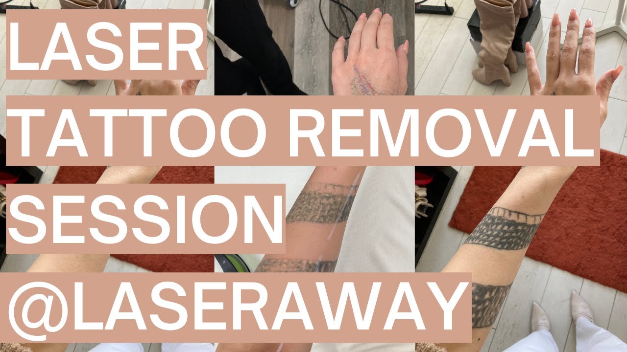Everything youve ever wanted to know about laser tattoo removal  Dazed