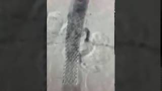 Karın Ağrısı, Karın Damarı Tıkanıklığı , Abdominal Aorta Darlığı Resimi