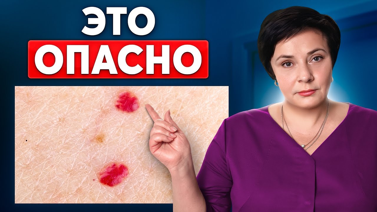 Красные точки на теле: Что такое ангиомы и как их лечить?