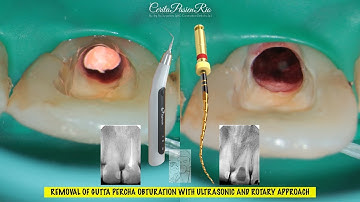 REMOVAL of gutta percha ultrasonic ultrax eighteeth & one curve micro-mega endodontic retreatment