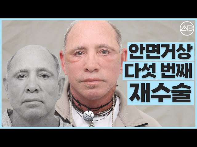 안면거상술만 5번째...이래도 되나? | 에이비성형외과