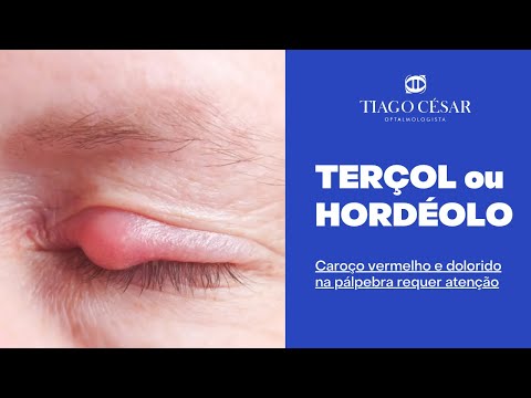 Clínica de Olhos Dr. Marco Tulio - Hordeolo ou terçol como é