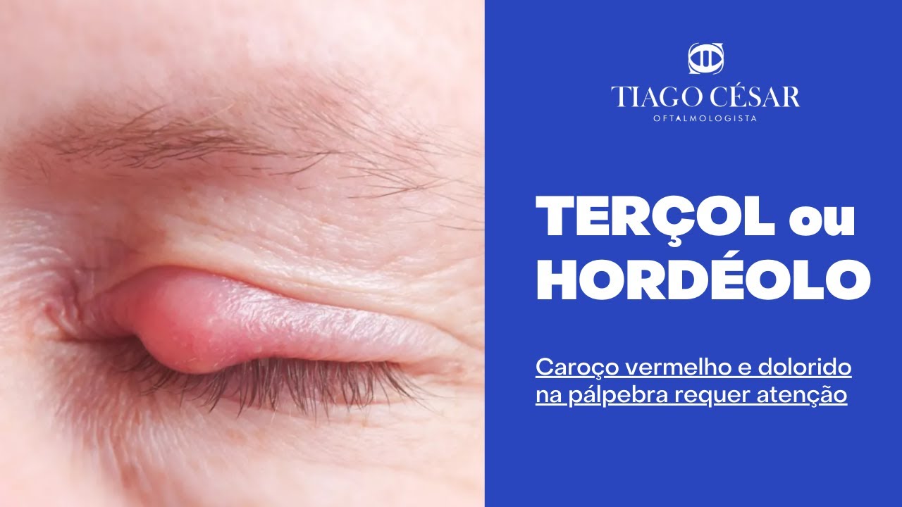 Hordéolo e Terçol: o que é, sintomas e tratamento - Dr. Gustavo