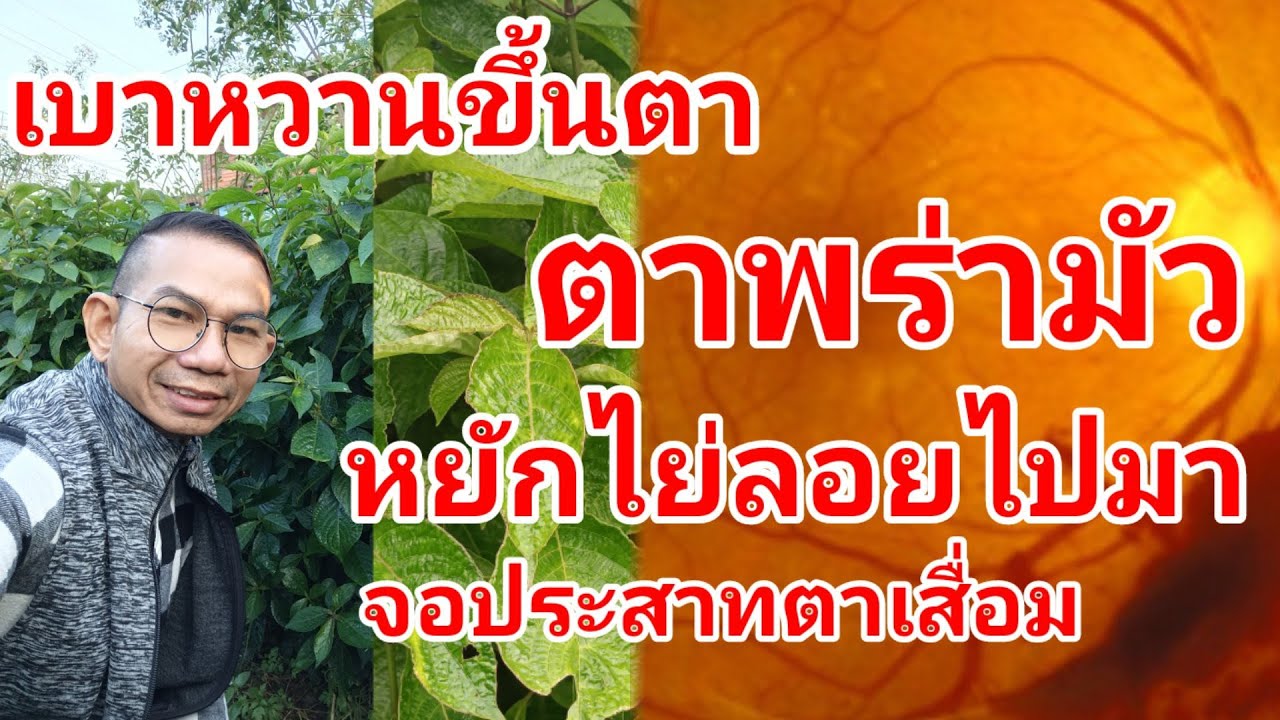 เบาหวานขึ้นตา ตาพร่ามัวเบลอ หยักไย่ลอยไปมา@สมุนไพร #โจฮักนะสารคาม #ลุงโจสมุนไพร EP.1593 - YouTube เบาหวานขึ้นตา ตาพร่ามัวเบลอ หยักไย่ลอยไปมา@สมุนไพร #โจฮักนะสารคาม #ลุงโจสมุนไพร Ep.1593 - Youtube