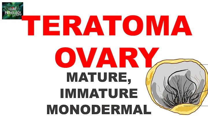 TERATOMA-OVARY:  Ovarian Tumor Series Part 5 - DayDayNews