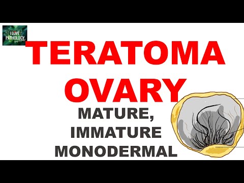 Video: Teratoma ovarian - karakteristikat, simptomat, diagnoza, trajtimi