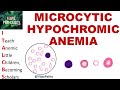 MICROCYTIC HYPOCHROMIC  ANEMIA.   Causes, Mechanism &amp; Approach