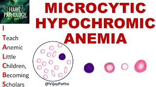 MICROCYTIC HYPOCHROMIC  ANEMIA.   Causes, Mechanism &amp; Approach