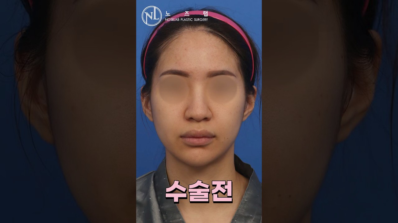 비개방 코성형 전후, 무엇이 달라질까? 노즈랩 강차영 원장이 말하는 코성형 체크포인트