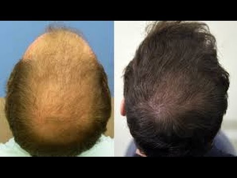 Лечение алопеции фото до и после Лечение алопеции фото до и после