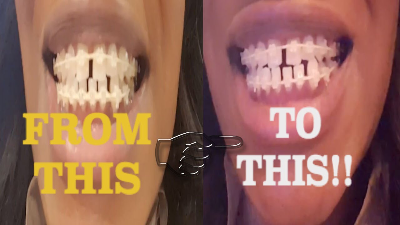 5 My Braces Journey Come with me to my new Dental Practice!! Bands go from Yellow to WHITE