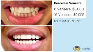 Smile Transformation