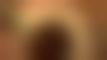 Calcified Intraocular lens post YAG laser exchanged by Steven G. Safran MD