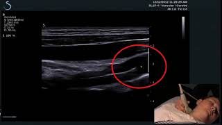 Hot Tips - Finding the Vertebral Artery with Ultrasound
