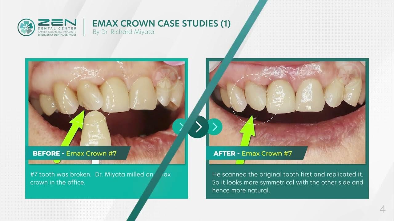 [Zen Dental] Emax Crown Case Studies (1) Dentist in Seattle