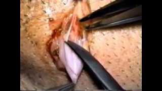 Microcirugía varicocelera de costo