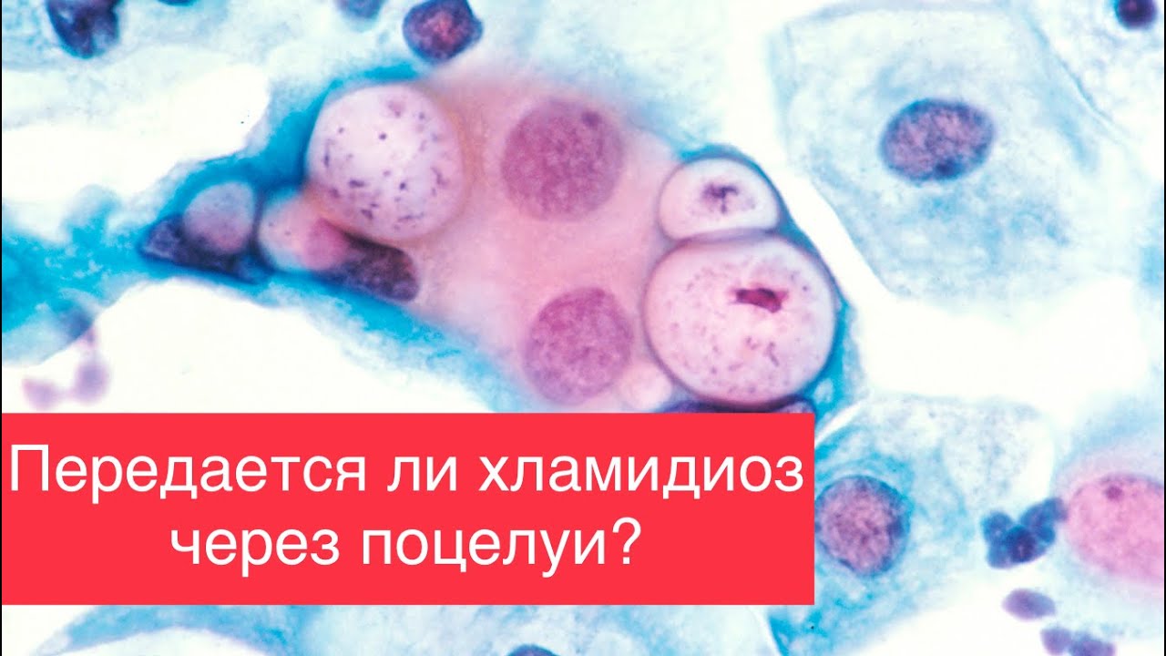 ХЛАМИДИОЗ. Признаки инфекции у мужчин. Как можно понизить риск ...