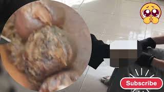 Heavy Jigger Infection Removal Intense Foot Care Therapy Yu731