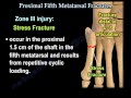 Proximal Fifth Metatarsal Fractures - Everything You Need To Know - Dr. Nabil Ebraheim