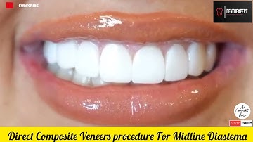 Midline Diastema closure with Veneers | Direct Composite Veneers procedure #vlog #dentist #composite