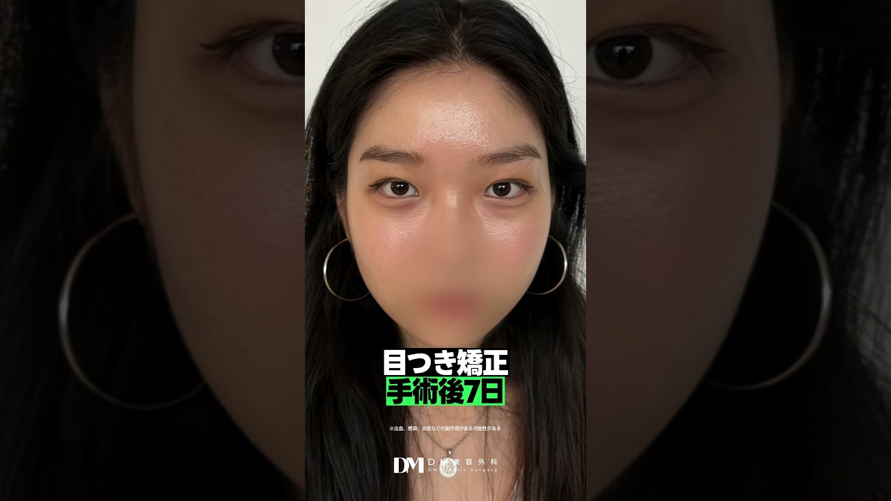 眠そうな目元を改善したい方必見👀｜眼瞼下垂手術（目つき矯正）で