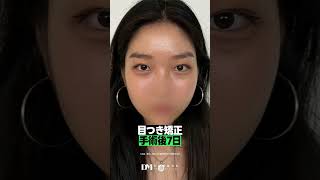 眠そうな目元を改善したい方必見👀｜眼瞼下垂手術（目つき矯正）で