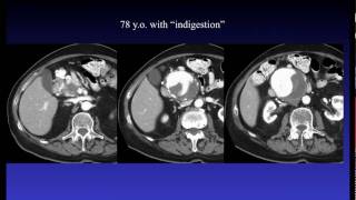 How to choose an embolic agent by William Rilling MD Part 1.mov