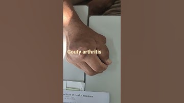 #gout#tophi#goutytophi GOUTY ARTHRITIS GOUTY TOPHI