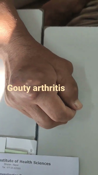 #gout#tophi#goutytophi GOUTY ARTHRITIS GOUTY TOPHI