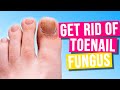 How To Get Rid of Toenail Fungus in 2024