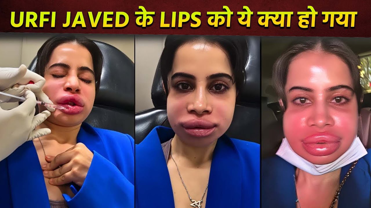 Urfi Javed Face Swollen After Lips, Causing Side Effects and Negative Impact  - YouTube