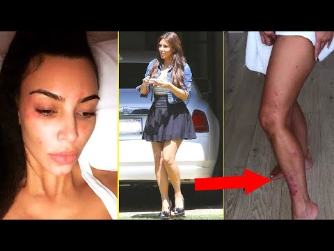 Vídeo: Kim Kardashian Estrelou Um Abraço Com Uma Modelo Com Uma Doença De Pele E Fãs Decepcionados