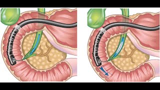 FLORIDA LIVE EDUCATIONAL VIDEO: ERCP MASTER CLASS ON RETRIEVAL OF MIGRATED STENTS