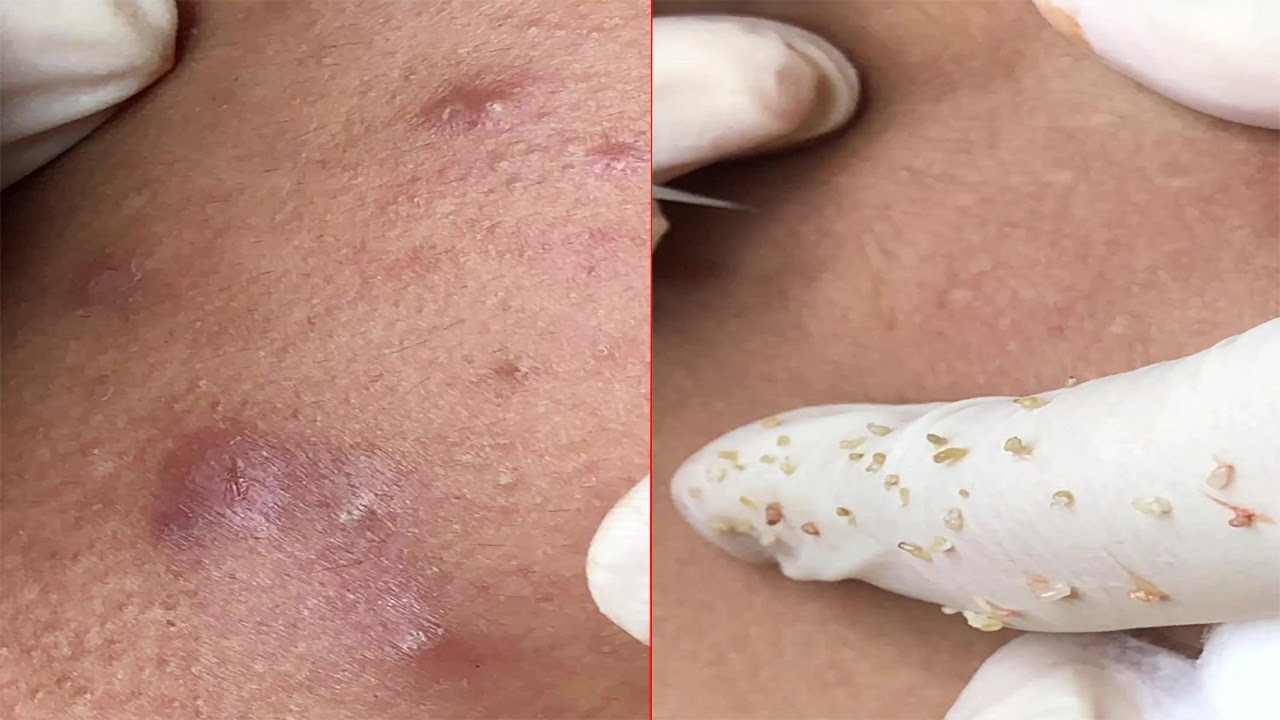 Đợi Mụn Tự Hết Và Cái Kết...
