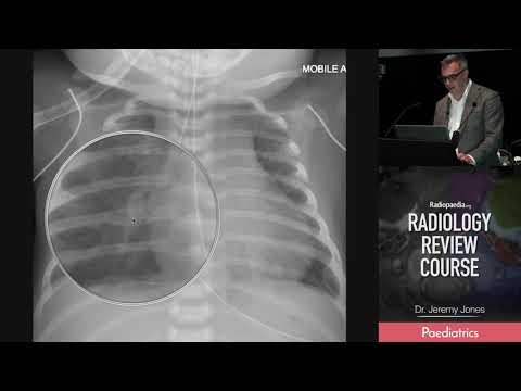 Video: Offset Ribfractuur