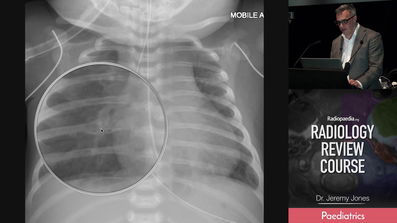 Xrays Of Broken Ribs