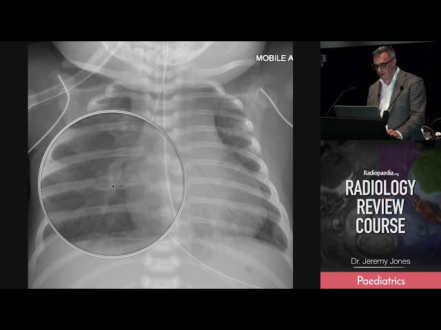 Broken Ribs X Ray
