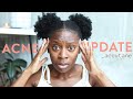 I Tried Accutane 🙅🏾 Issa No For Me Dawg | Adult Acne Update #2