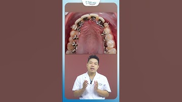Quá Trình Niềng Răng Bằng Mắc Cài Mặt Lưỡi | Nha Khoa Minh Châu