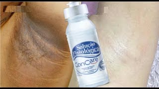 CLAREEI MINHAS AXILAS EM 20 MINUTOS COM SORO FISIOLÃ“GICO!(Desafio de clareamento das axilas)!!!