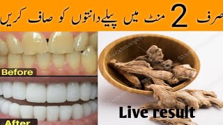 Natural Way to Whiten Your Teeth - (Home remedy) Cleaning Teeth only 5 minutes