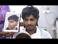 Cleft lip nose deformity Rhinoplasty - Moustache Transplant - Before & After results